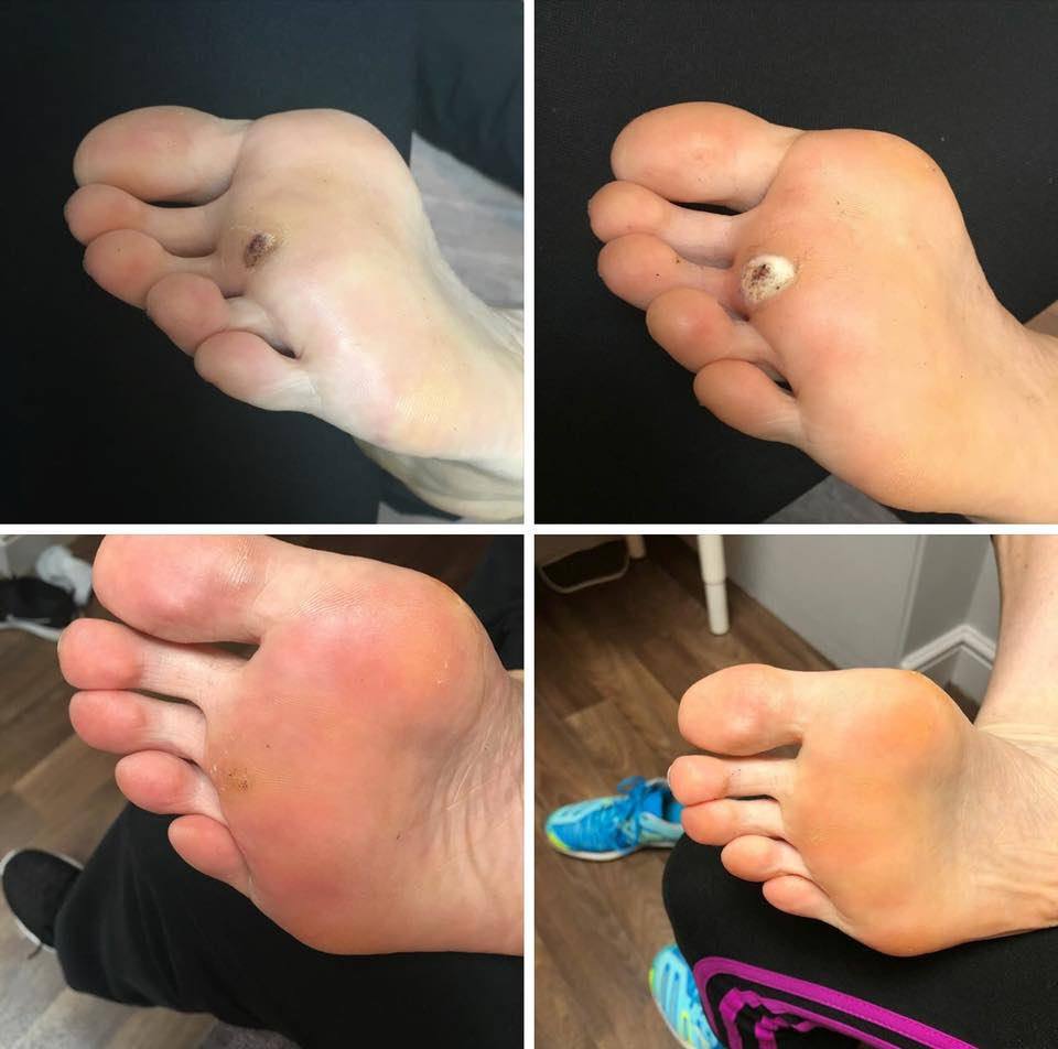 Verruca removal before and after results